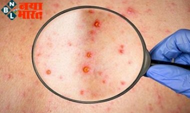 Monkeypox Alert: देश पर मंडराने लगा मंकीपॉक्‍स का खतरा, केंद्र ने एयरपोर्ट और बंदरगाहों को लेकर  किया अलर्ट जारी