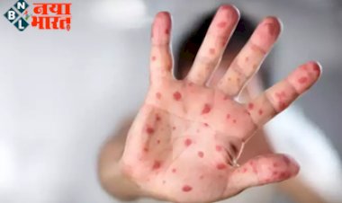 Monkeypox Virus: कई देशों तक पहुंचा 'मंकीपॉक्स वायरस', WHO ने दी मामले बढ़ने की चेतावनी, जानिए इससे जुड़ी बड़ी बातें
