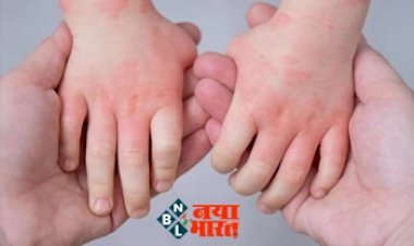 Tomato Flu: बच्चों पर आई नई मुसीबत, तेज़ी से फैल रहा है 'टमाटर फ्लू', जानें कारण, लक्षण और इलाज.
