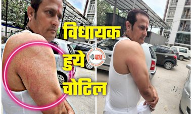 CG- विधायक हुये चोटिल BIG NEWS: छत्तीसगढ़ के संसदीय सचिव एवं विधायक विकास उपाध्याय दिल्ली में हुए चोटिल.... एआईसीसी प्रभारी महामंत्री की पुलिस हिरासत में बिगड़ी तबियत.... देखें जख्म से भरे तस्वीरें.....