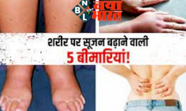 Swelling on Body and Face: शरीर पर सूजन बढ़ाने वाली 5 बीमारिया !  इस कारण अंगों में होने लगती है सूजन, भूलकर भी न करें नजरअंदाज...