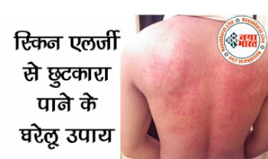 Home Remedies To Get Rid Of Skin Allergies : स्किन एलर्जी से छुटकारा पाने के लिए अपनाये ये घरेलू उपाय, जाने इसके कारण, लक्षण और घरेलू इलाज...
