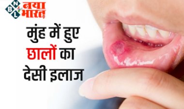 Home remedy tips: मुंह में छाले होने से हैं परेशान, तो आजमाएं ये घरेलू देसी नुस्खे जल्द मिलेगा आराम...