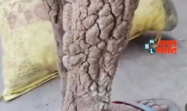 Bark on Limbs : हाथ-पैर पर पेड़ की छाल जैसी परत! इस गंभीर बीमारी से पीड़ित है बच्ची...मदद के लिए आगे आये सोनू सूद...