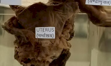 CG-ऑपरेशन थियेटर में सर्जरी के दौरान डॉक्टर हुए हैरान...27 साल के लड़के के पेट से निकला गर्भाशय...फिर जो हुआ…ऐसे दुनिया में सिर्फ इतने मामले...