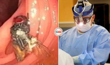 Live Fly found in Intestine : डॉक्टर की फटी रह गई आँखे! शख्स की आंत में मिली जिंदा भिनभिनाती हुई मक्खी, जाने पूरा मामला...