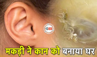 Spider Web in Female's Ear : महिला टीचर के कान में मकड़ी ने बनाया घर, आती थी खरोंचने की आवाज; कानों की नियमित सफाई न करना पड़ा भारी....
