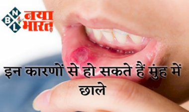 Mouth Ulcers: क्या आप भी मुंह के छालों से रहते हैं परेशान? इन कारणों से भी हो सकते है मुंह के छाले...
