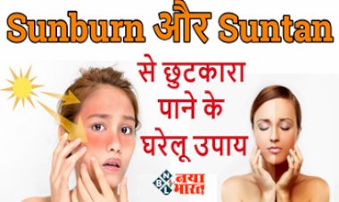How to Get Rid of Sunbrun : सनबर्न और टैनिंग से पाना चाहते है छुटकारा! तो अपनाये ये घरेलू नुस्खे, चमक जाएगी आपकी त्वचा...