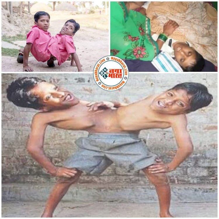 CG VIDEO जुड़वा भाइयों की मौत: CG के चर्चित जुड़वां भाई की संदिग्ध परिस्थिति में मौत…आत्महत्या या फिर कुछ और….4 हाथ व 2 सिर वाले जुड़वा भाइयो पर बन चुकी है कई डाक्यूमेंट्री.…अंतराष्ट्रीय स्तर के टीवी शो में दिखाई गयी थी दोनों की कहानी….देखे विडियो…….