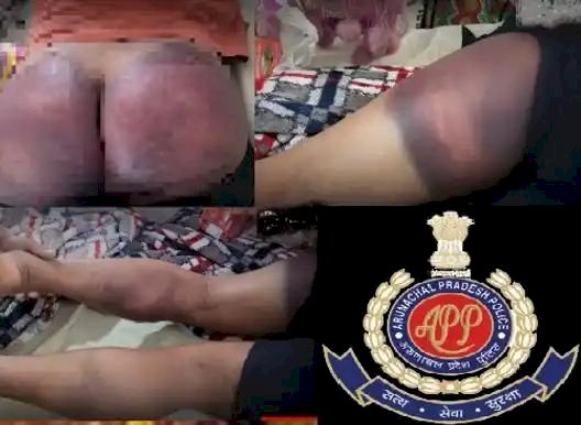 Arunachal news: एक कांस्टेबल का खौफनाक चेहरा सामने आया,एक युवक की बुरी तरह पीटाई कर दिया जिसको देख कर अंतर्राष्ट्रीय मानवाधिकार संगठन भी हिल गई।