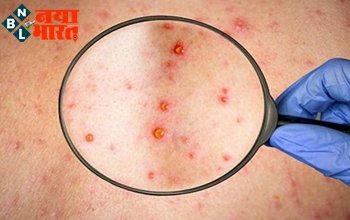 Monkeypox Alert: देश पर मंडराने लगा मंकीपॉक्स का खतरा, केंद्र ने एयरपोर्ट और बंदरगाहों को लेकर किया अलर्ट जारी