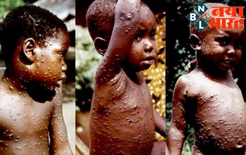 Monkeypox को लेकर भारत में भी बढ़ी चिंता, केंद्र सरकार ने जारी किया अलर्ट-लापरवाही ना बरतें.