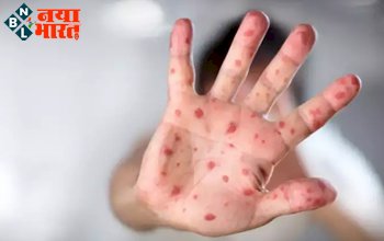 Monkeypox Virus: कई देशों तक पहुंचा 'मंकीपॉक्स वायरस', WHO ने दी मामले बढ़ने की चेतावनी, जानिए इससे जुड़ी बड़ी बातें