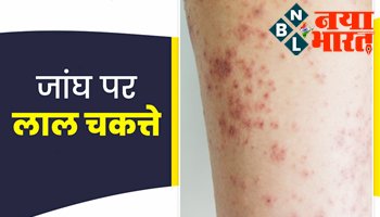 Red rash on the thigh : जांघों में खुजली और लाल चकत्ते आने से हैं परेशान...तो अभी करे ये 5 घरेलू उपाय...थोड़े ही समय में मिलेगी राहत...