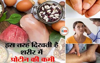 Protein Deficiency: स्वस्थ शरीर के लिए प्रोटीन है जरूरी, प्रोटीन की कमी से शरीर में दिखते हैं ये लक्षण...
