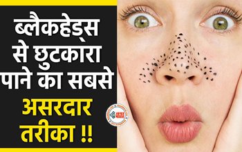 Beauty Tips : अब चेहरे से Blackheads की होगी छुट्टी, इन आसान उपायों को जल्दी अपनायें, चेहरे की बढ़ेगी चमक, आएगा पहले से भी ज्यादा निखार...