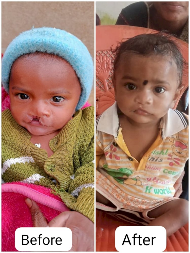 मिली मयंक को नई पहचान .., कटे होंठ से मिली मुक्ति चेहरे पर आई नई मुस्कान