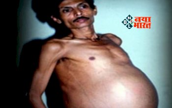 36 Year Old Man Gave Birth to Twins : 36 साल तक प्रेग्नेंट रहा यह आदमी, फिर जुड़वा बच्चो को दिया जन्म, डॉक्टरो के भी उड़ गये होश, यहाँ जाने पूरा मामला...