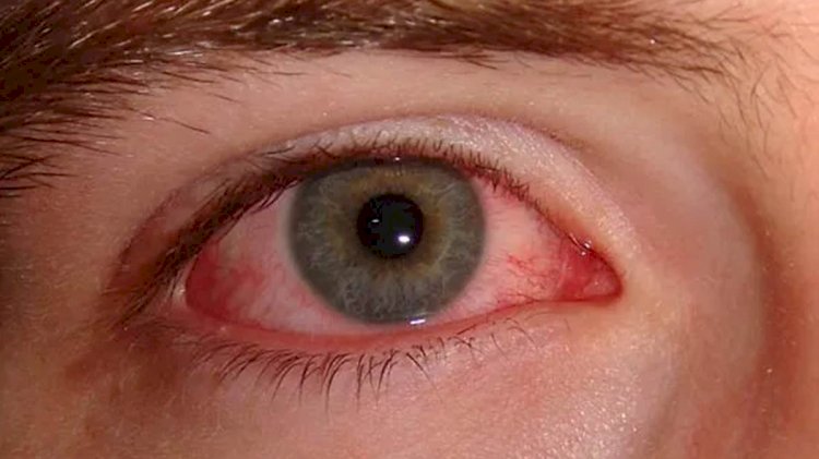 Eye Flu In CG : तेजी से बढ़ रहा आई फ्लू का खतरा, स्वास्थ्य विभाग ने जारी की गाइडलाइन, राजधानी में मिले इतने केस