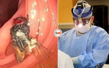 Live Fly found in Intestine : डॉक्टर की फटी रह गई आँखे! शख्स की आंत में मिली जिंदा भिनभिनाती हुई मक्खी, जाने पूरा मामला...
